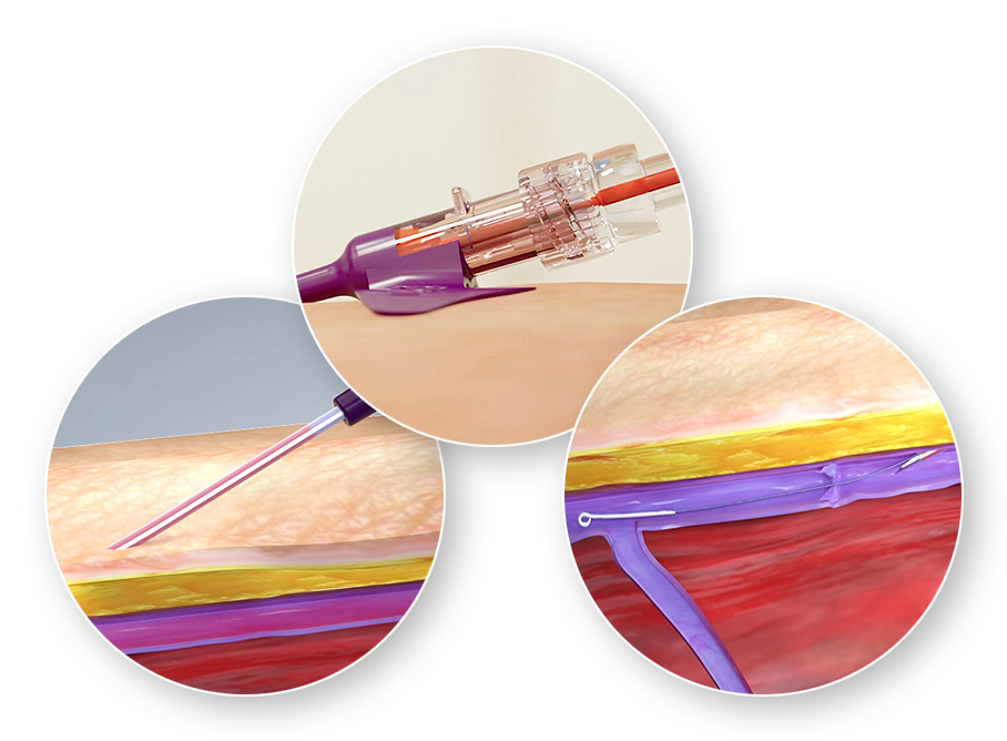 Venocare Three Point-of-Vessel Entry Confirmation